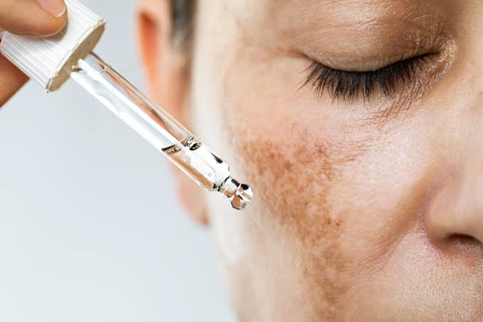 Tratamento de melasma